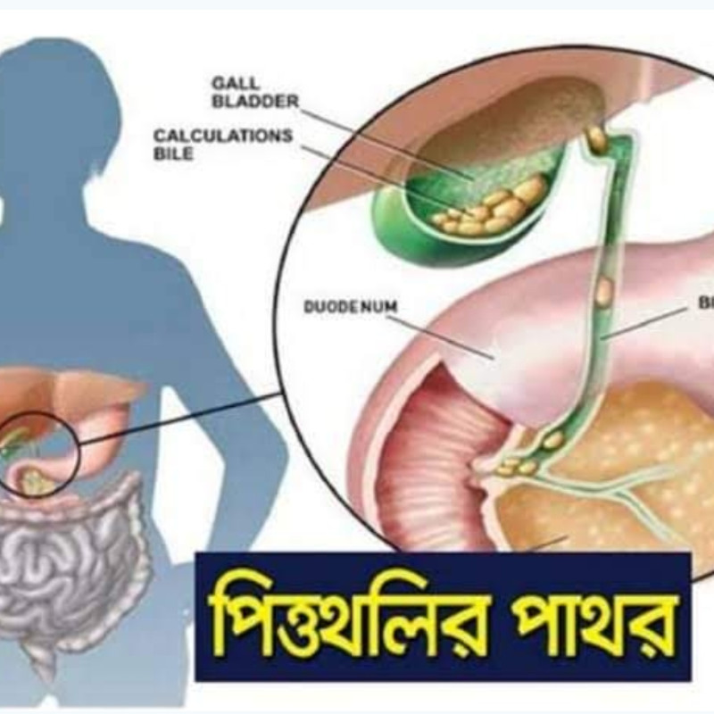পিত্তথলির পাথর বা গলব্লাডার স্টোন: