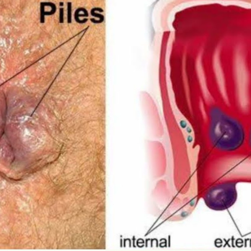 Amelux Arsho Piles Fistula Removal
