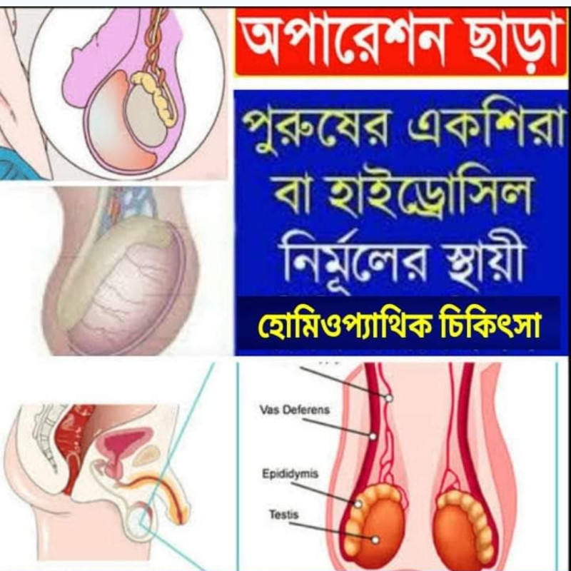একশিরা বা হাইড্রোসিল নির্মূলে হোমিওপ্যাথি চিকিৎসা :
